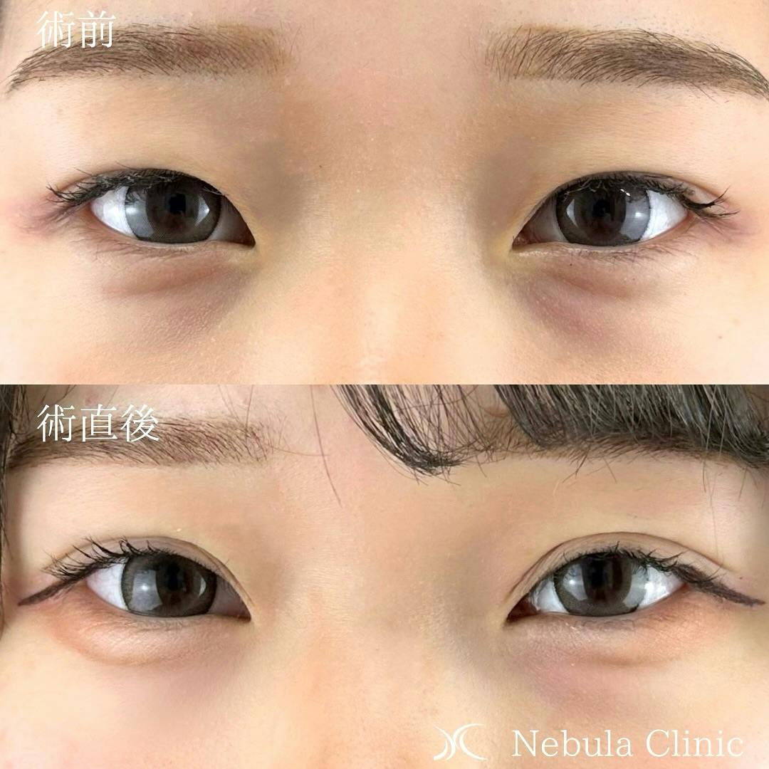 【女性・目元】二重埋没法_before_aftar