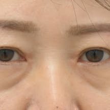 【50代女性・目元】眉下リフト(眉下切開)_after