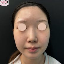 【20代女性・輪郭】小顔用脂肪吸引注射、その他の治療法_before
