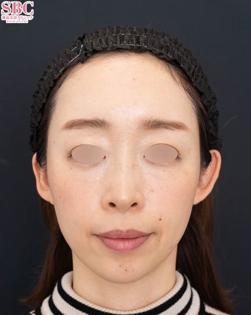 【30代女性・顔】SBCプレミアムPRP皮膚再生療法（額／こめかみ／目の上／法令線）_after