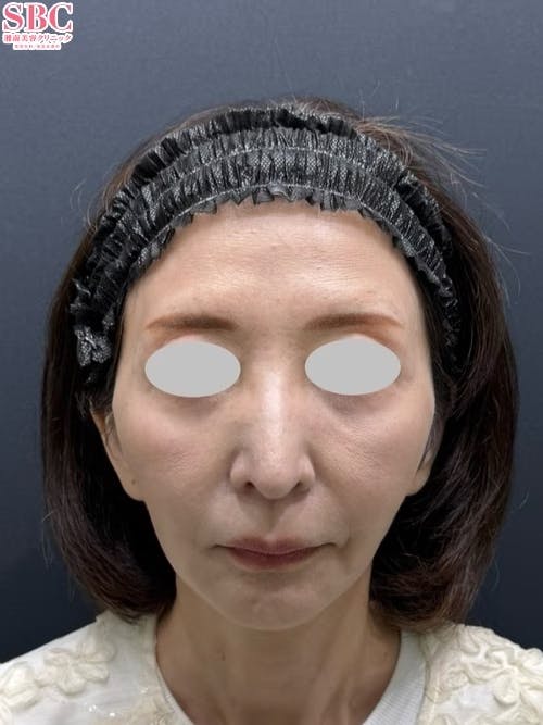 【60代女性・たるみ】スマスフェイスリフト_after