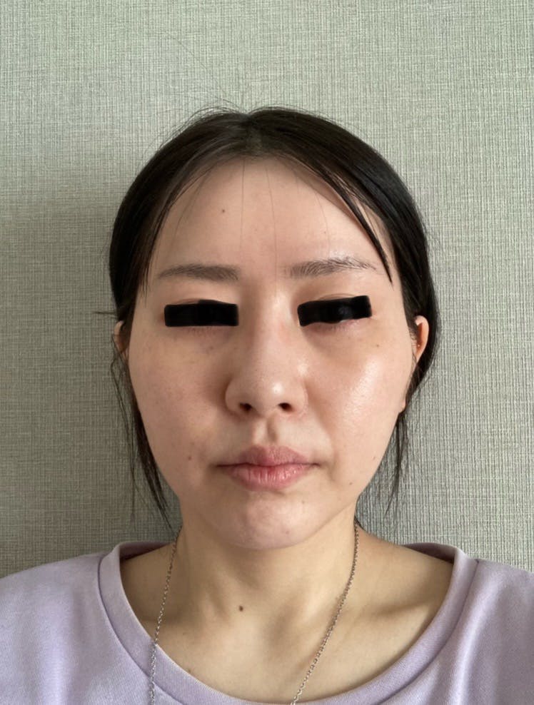 聖心美容クリニック 銀座院でヒアルロン酸分解注射・他院修正を受けたpeanutsさんの写真