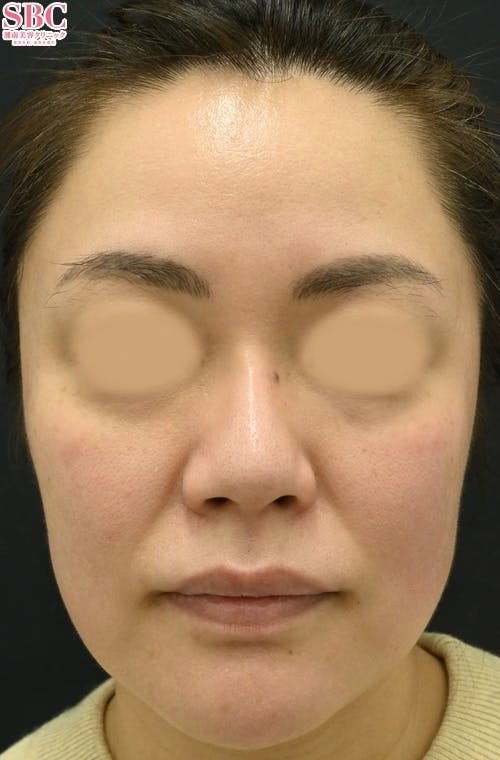 【女性・たるみ】女優注射(R)~リジュラン＋ボトックス~、プロファイロ_after