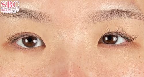 【30代女性・目元】目頭切開プレミアム_before