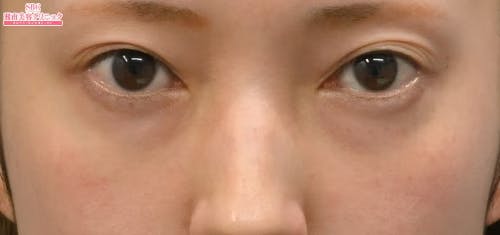 【30代女性・目元】目の下の切らないクマ・たるみ（ふくらみ）取り ナチュラル脂肪注射コンデンスリッチ ナチュラル脂肪注射ナノリッチ_before