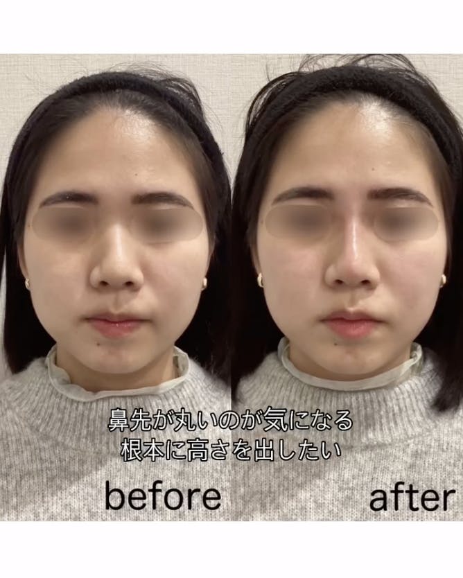 【女性・鼻】ヒアルロン酸（鼻根部、鼻先）_before_aftar