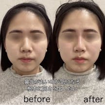【女性・鼻】ヒアルロン酸(鼻根部、鼻先)_before_aftar