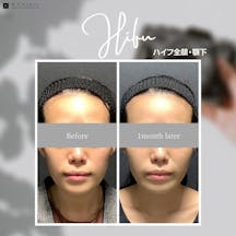 【女性・輪郭】ハイフ全顔・あご下コース_before_aftar