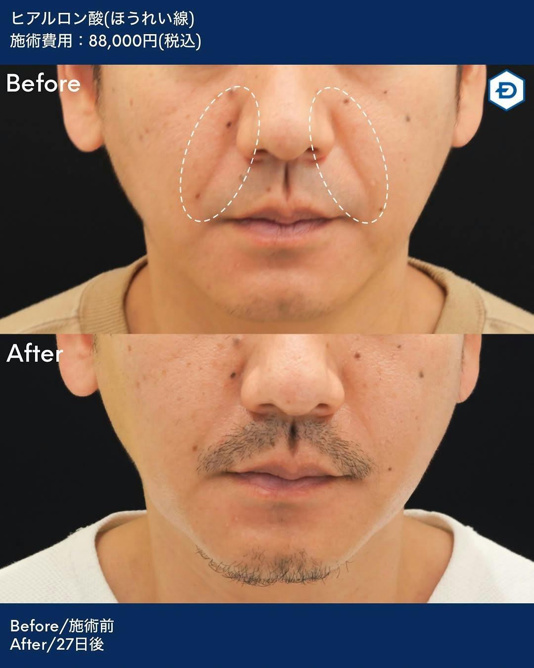 【男性・ほうれい線】ヒアルロン酸注入(ほうれい線)_before_aftar
