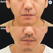 【男性・ほうれい線】ヒアルロン酸注入(ほうれい線)_before_aftar