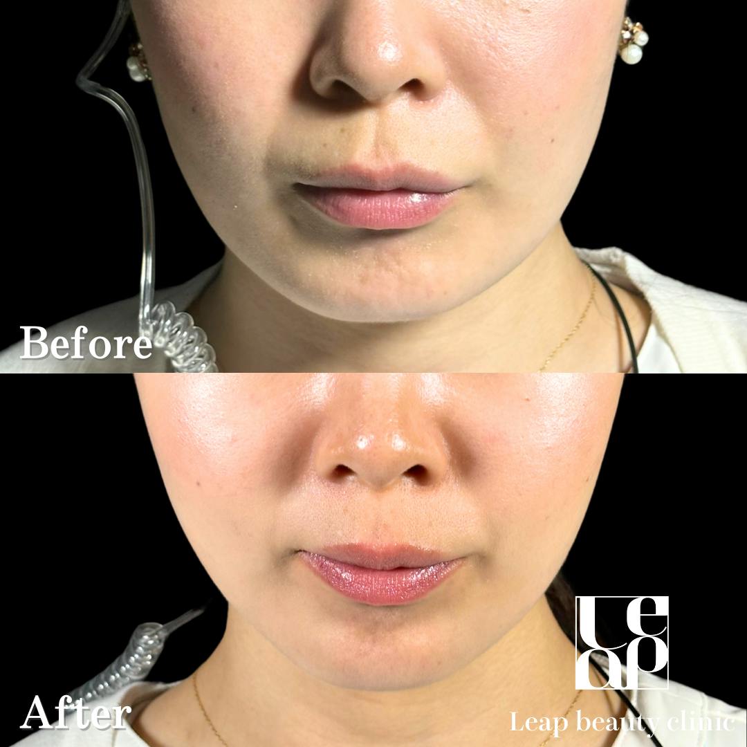 【30代女性・輪郭】TESSリフト_before_aftar