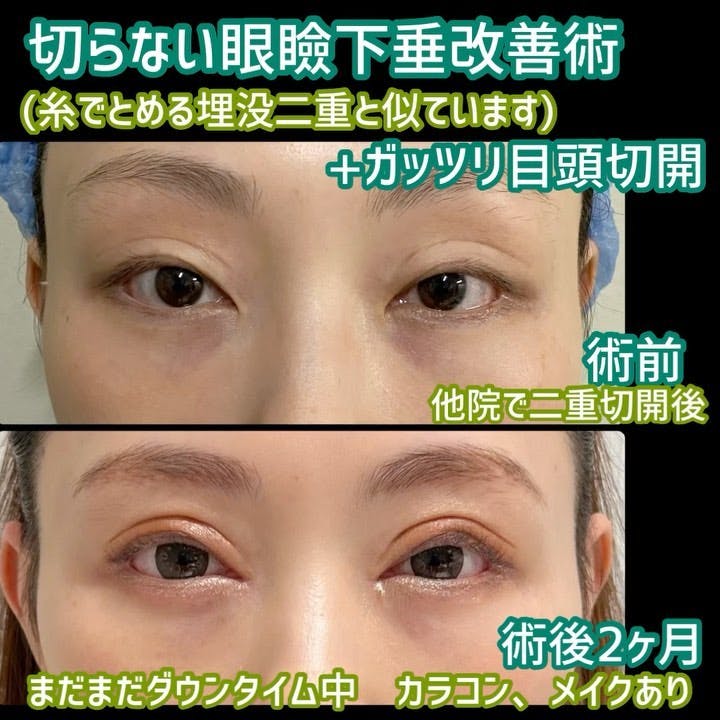 【女性・目元】切らない眼瞼下垂術、目頭切開術_before_aftar