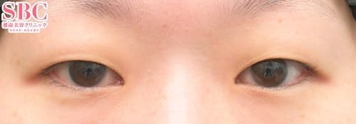 【女性・目元】クイックコスメティーク・トリプルNeo_before