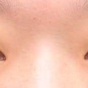 【女性・目元】クイックコスメティーク・トリプルNeo_before