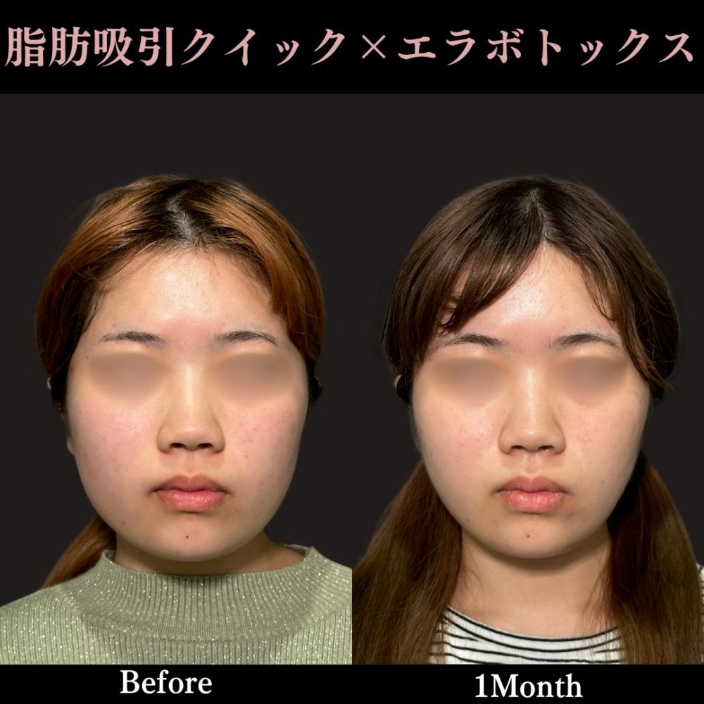 【20代女性・顔】脂肪吸引クイック（頬）＋エラボトックス_before_aftar