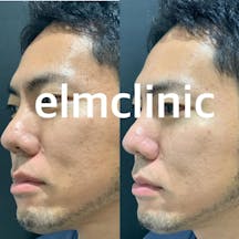 【男性・毛穴】ハイドラジェントル_before_aftar