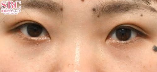 【女性・目元】クイックコスメティーク・ダブルNeo 自然癒着セット（上眼瞼脱脂）_aftar