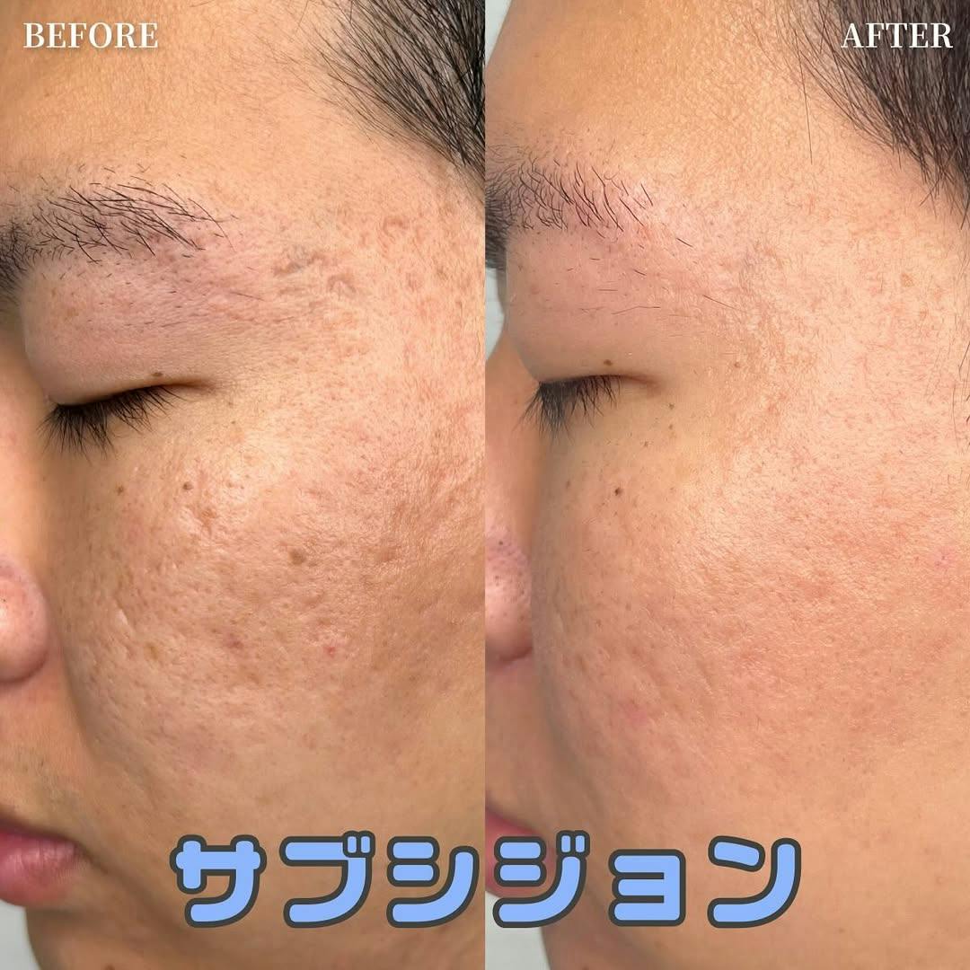 【男性・顔】サブシジョン_before_aftar