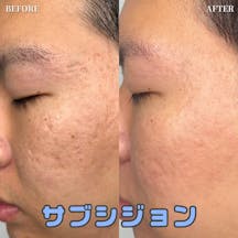 【男性・顔】サブシジョン_before_aftar