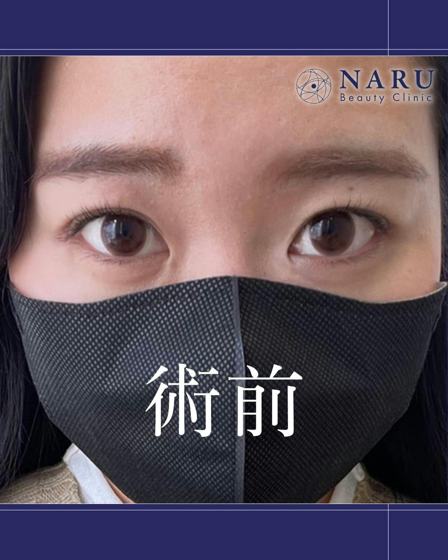 【女性・目元】二重埋没法_before