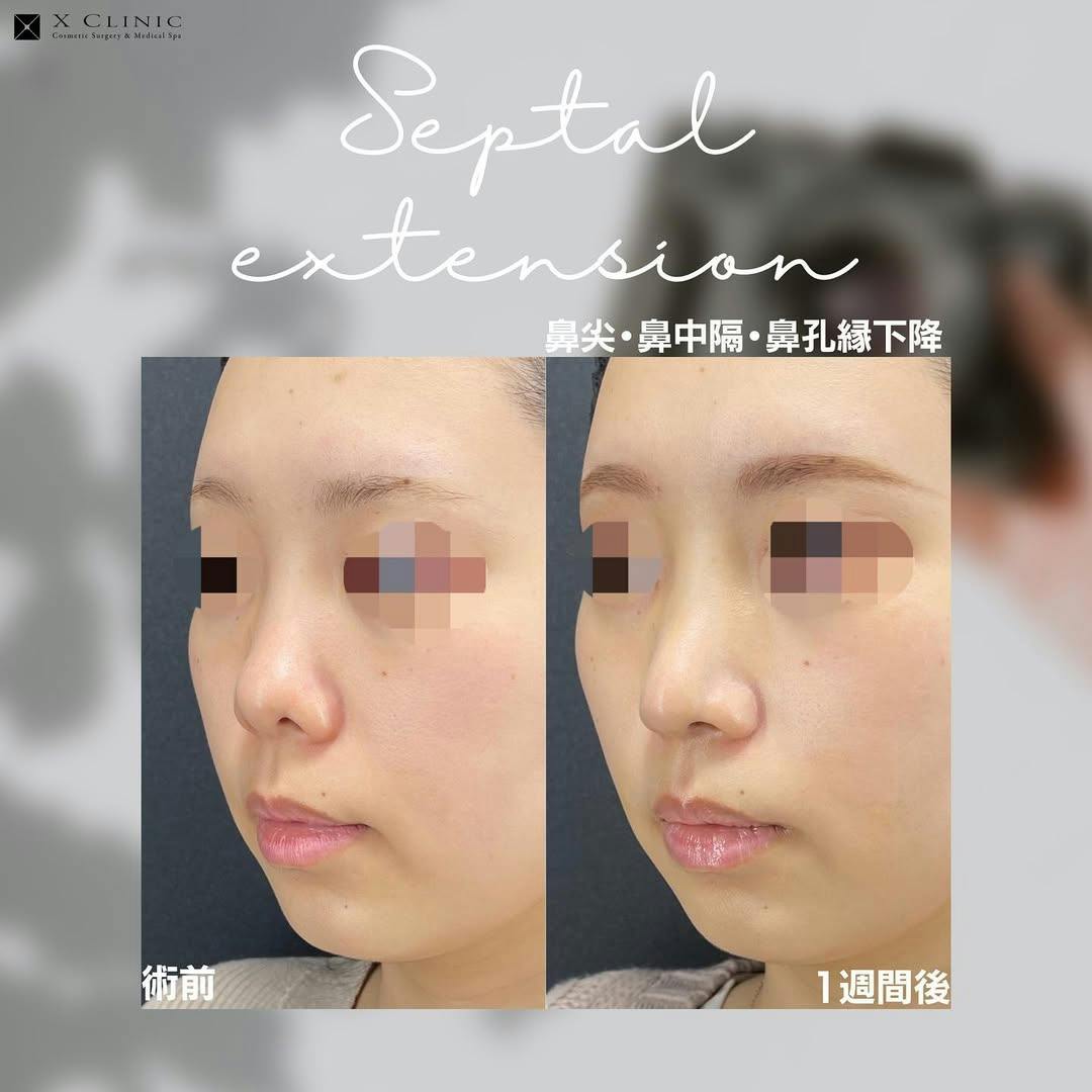 【女性・鼻】鼻尖·鼻中隔·鼻孔縁下降_before_aftar