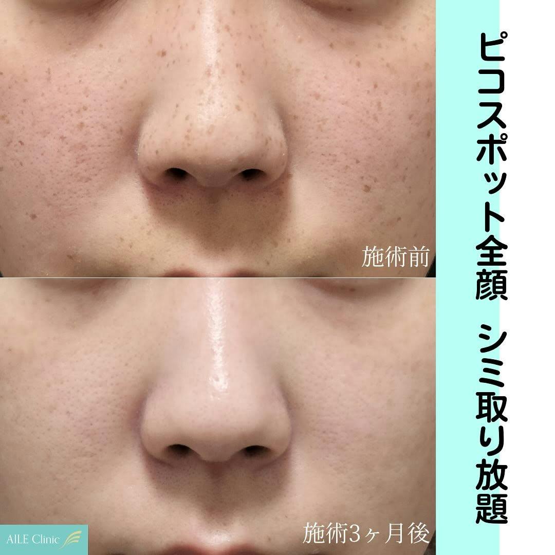 【女性・シミ】ピコスポット全顔_before_aftar