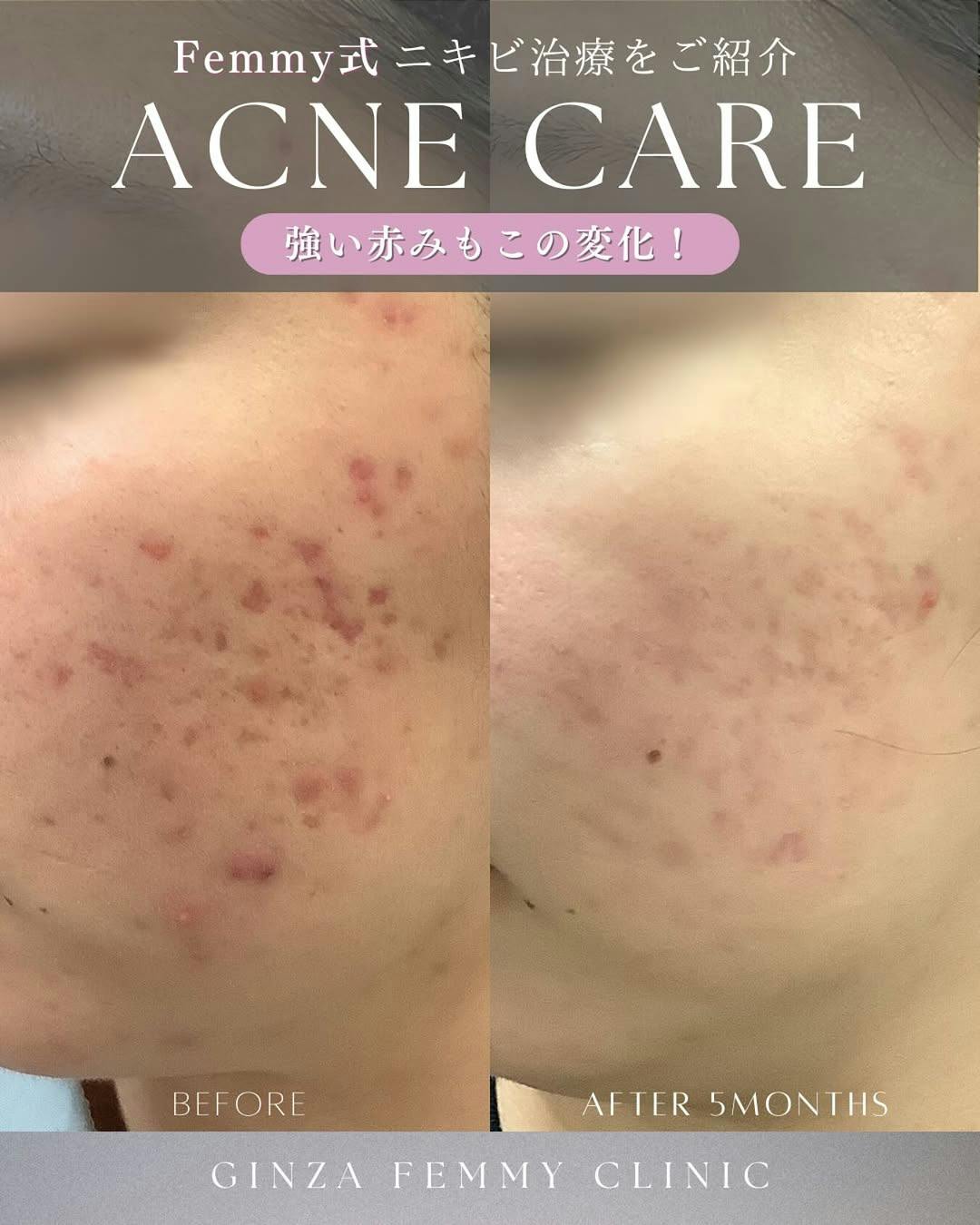 【赤み】ケミカルピーリング・クロモライト_before_aftar