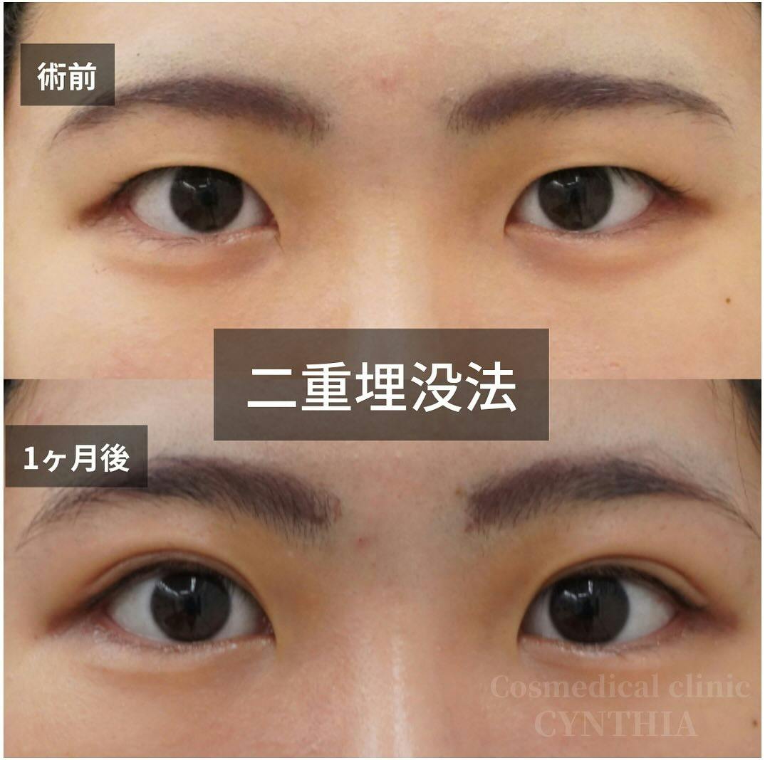 【20代女性・目元】二重埋没法_before_aftar