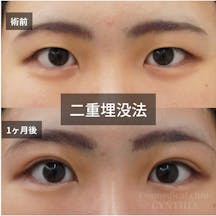 【20代女性・目元】二重埋没法_before_aftar