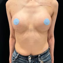 【女性・胸】CEREFORM(R)(セレフォーム)(バッグ豊胸)_1month