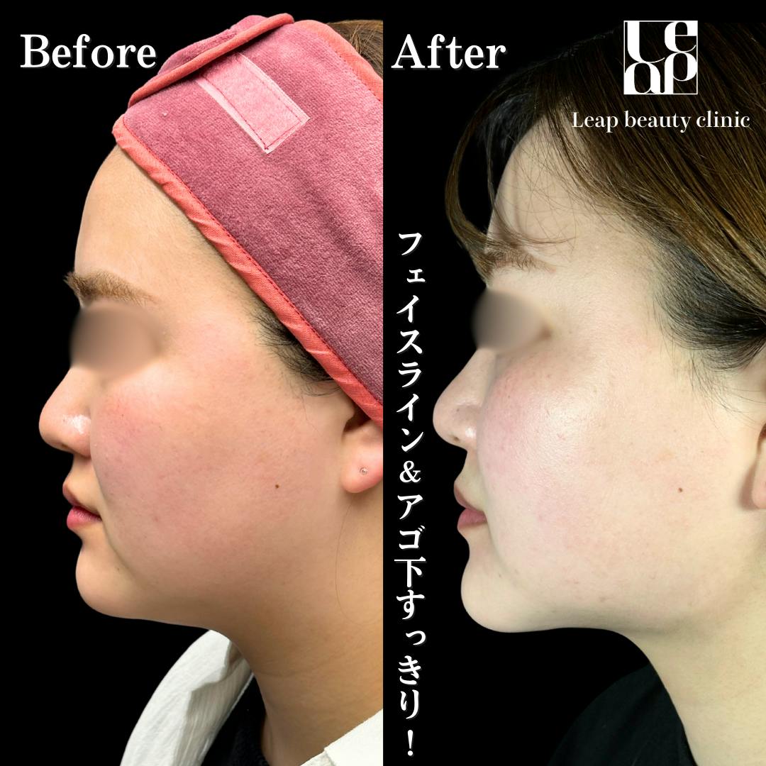 【20代女性・輪郭】頬・顎下脂肪吸引・TESSリフト_before_aftar