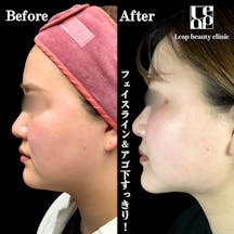 【20代女性・輪郭】頬・顎下脂肪吸引・TESSリフト_before_aftar