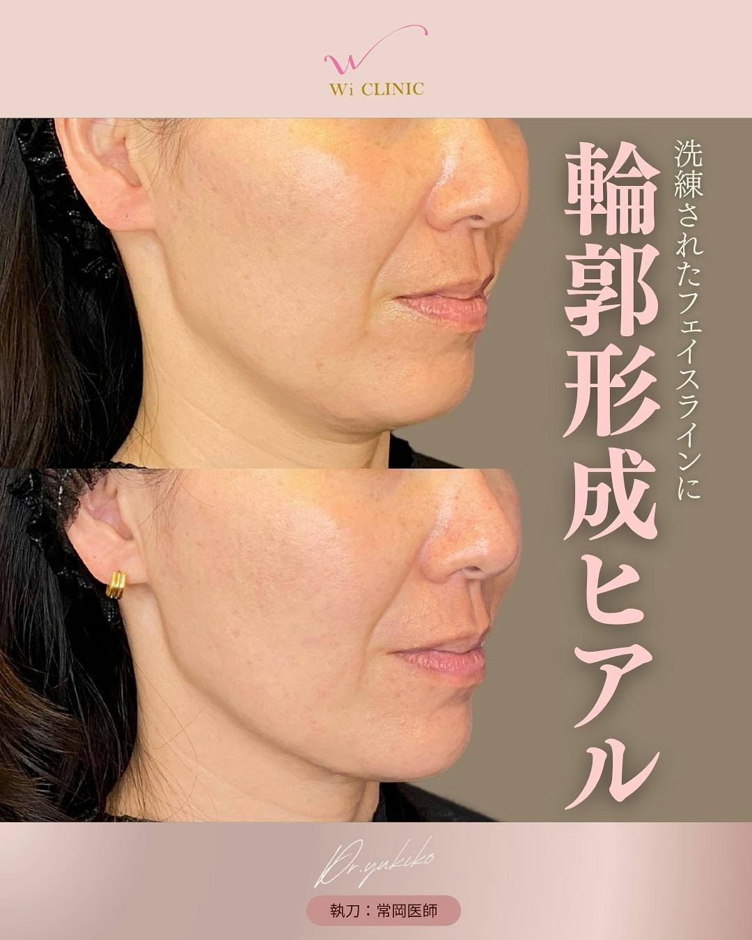 【女性・輪郭】ヒアルロン酸注入_before_aftar