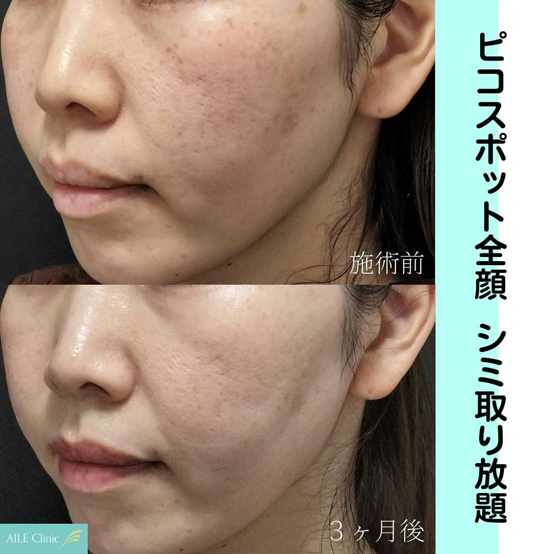 【女性・シミ】ピコスポット全顔_before_aftar