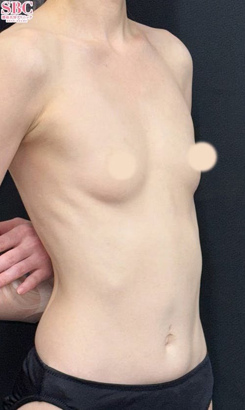 【女性・胸】コンデンスリッチ(脂肪注入豊胸)2回目・Aquicell（アキーセル）併用コンデンスリッチ(脂肪注入豊胸)_before