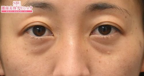 【30代女性・目元】目の下の切らないクマ・たるみ（ふくらみ）取り ナチュラル脂肪注射コンデンスリッチ ナチュラル脂肪注射ナノリッチ_before