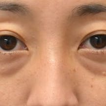 【30代女性・目元】目の下の切らないクマ・たるみ(ふくらみ)取り ナチュラル脂肪注射コンデンスリッチ ナチュラル脂肪注射ナノリッチ_before