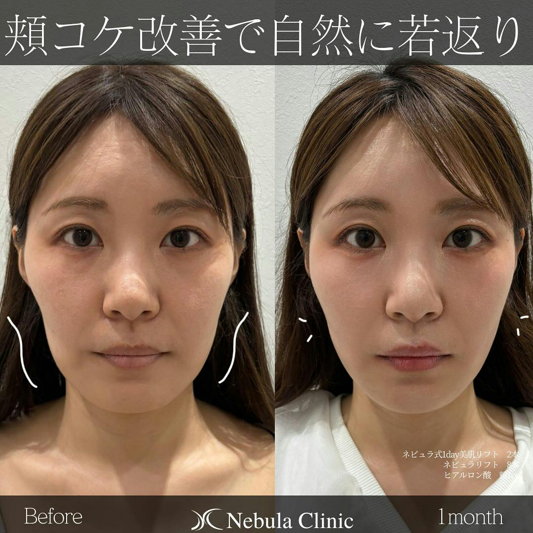 【女性・顔・頬】糸リフト、ヒアルロン酸注入(頬)_before_aftar