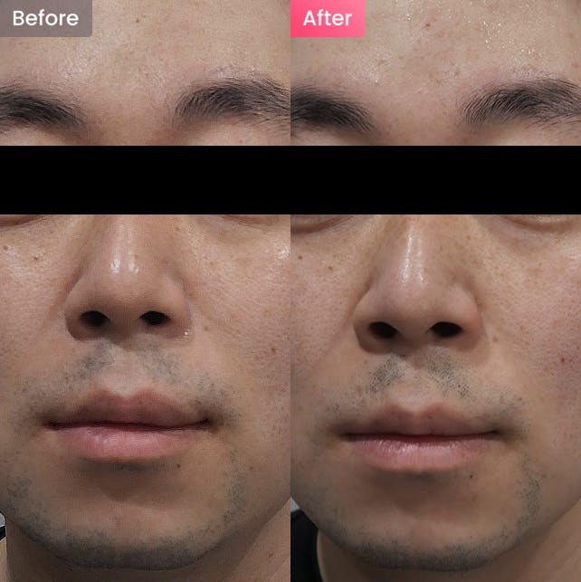 【男性・シミ】頬のシミやそばかすが気になるの写真