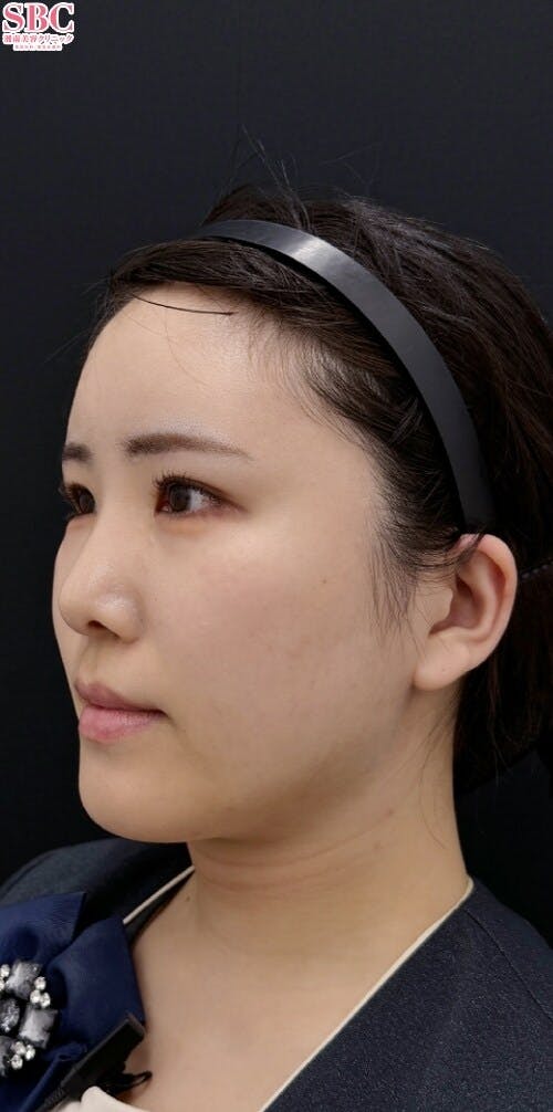 【20代女性・たるみ】ナチュラル脂肪注射コンデンスリッチ、ナチュラル脂肪注射ナノリッチ_after