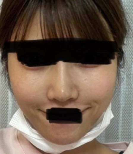 THE CLINIC（ザ・クリニック）東京院で顔の脂肪注入：ほうれい線(両側)を受けたさぁ子さんの写真