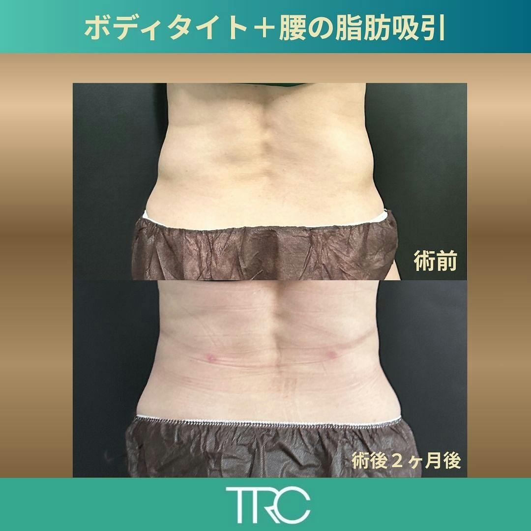 【女性・腰】ボディタイト＋腰部脂肪吸引_before_aftar