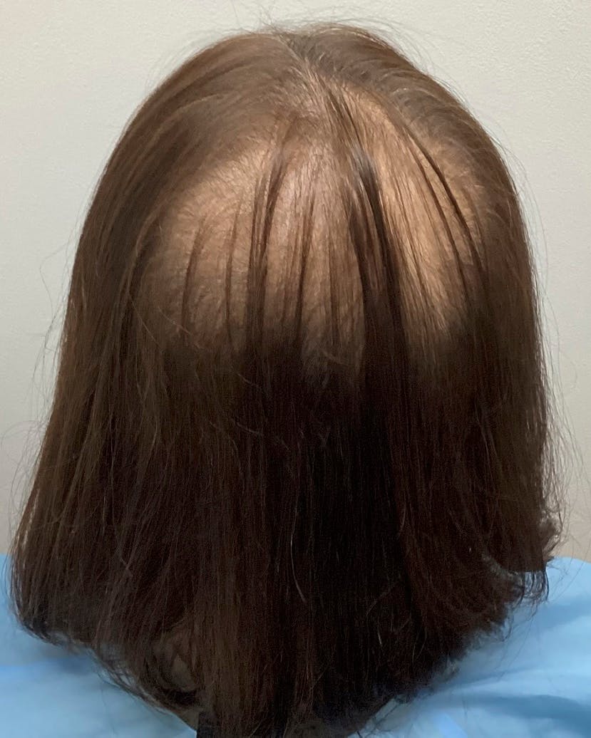 【56歳女性・頭髪】薄毛治療_before