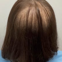 【56歳女性・頭髪】薄毛治療_before