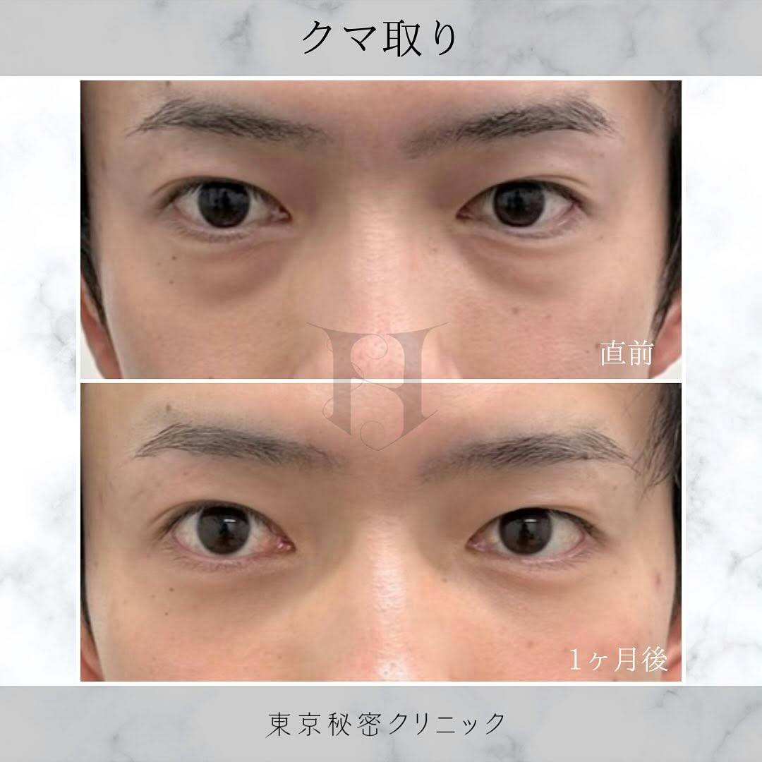 【男性・目元】クマ取り_before_aftar
