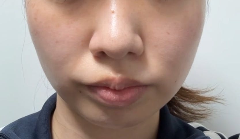 湘南美容クリニック 錦糸町院でIPL フォトダブルを受けたみなさんの写真