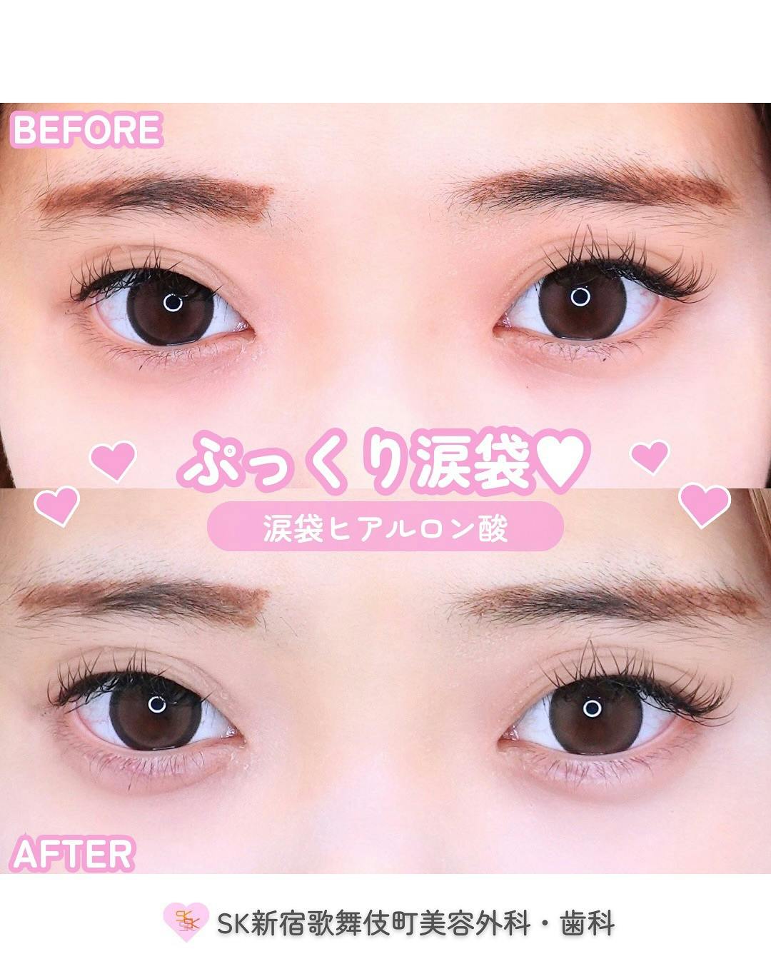 【女性・目元】涙袋ヒアルロン酸_before_aftar