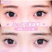 【女性・目元】涙袋ヒアルロン酸_before_aftar