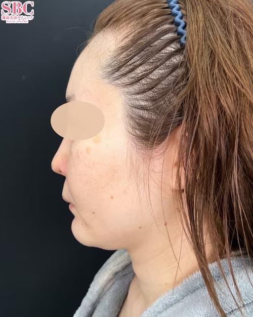 【女性・小顔】根こそぎVASER脂肪吸引、ジョールファット除去術、メーラーファット除去術_before