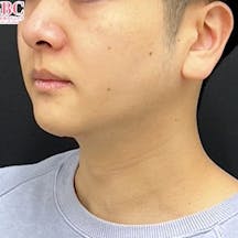 【20代男性・顔】根こそぎVASER脂肪吸引、ジョールファット除去術、あざむくみ抑制ドレナージュ_after